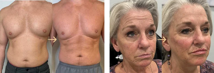 Body Contouring before and after results at Sweet Spot MediSpa
