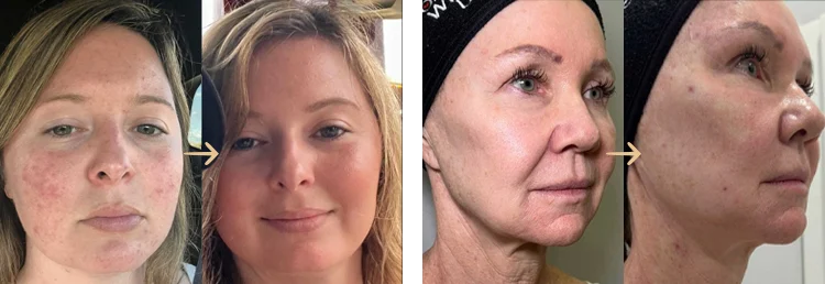 Skin Rejuvenation before and after results at Sweet Spot MediSpa